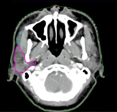 Contouring the accessory parotid gland and major parotid glands as a single organ at risk during nasopharyngeal carcinoma radiotherapy